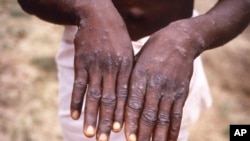 Monkeypox Africa